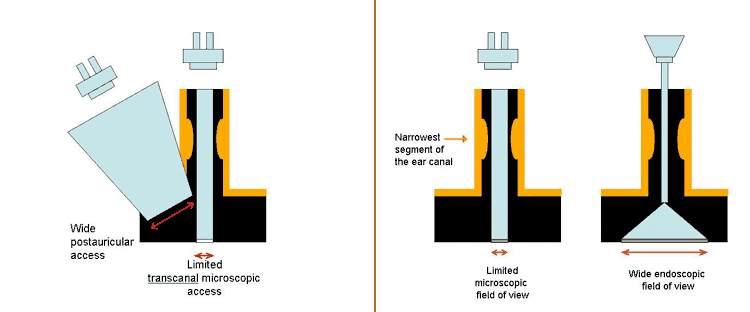 enscopic ear surgery field of view